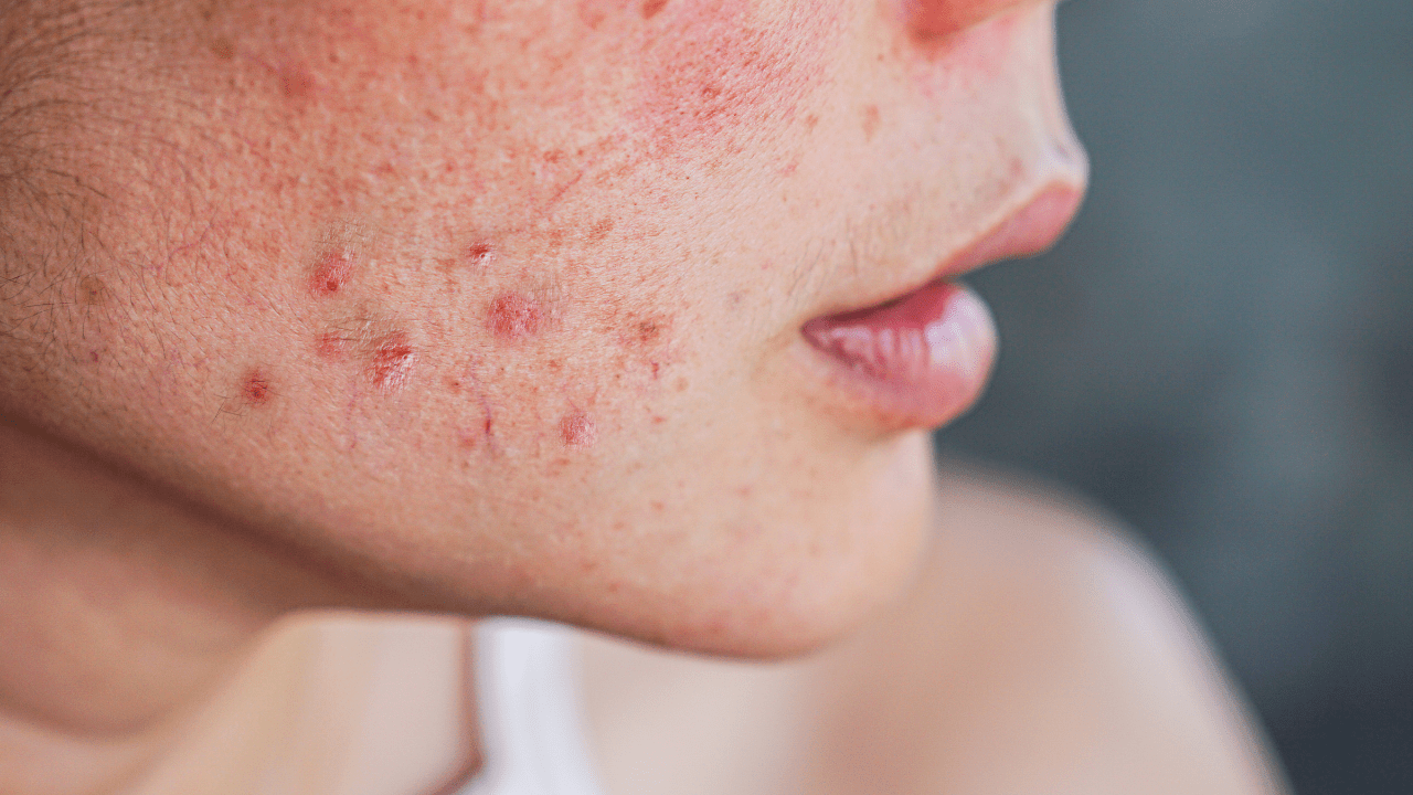 Woman with acne and inflammation on face